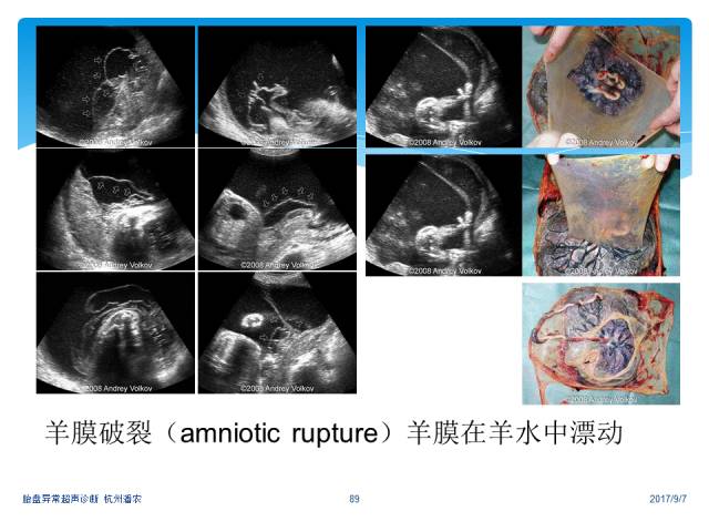 超声微课堂胎盘异常的超声诊断思路羊膜腔异常回声光带