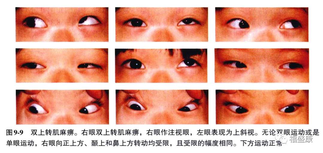 眼位第一眼位常为受累眼下斜视,双眼上转时患眼下斜视更明显.