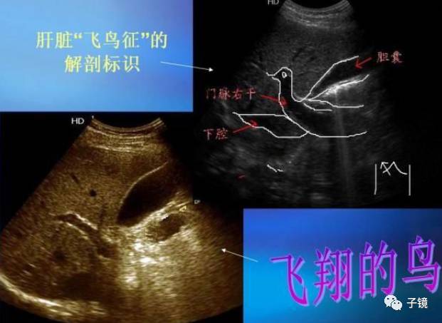 孙英姿老师肝胆疾病的超声诊断学习笔记2017山东省第三届超声引导经皮