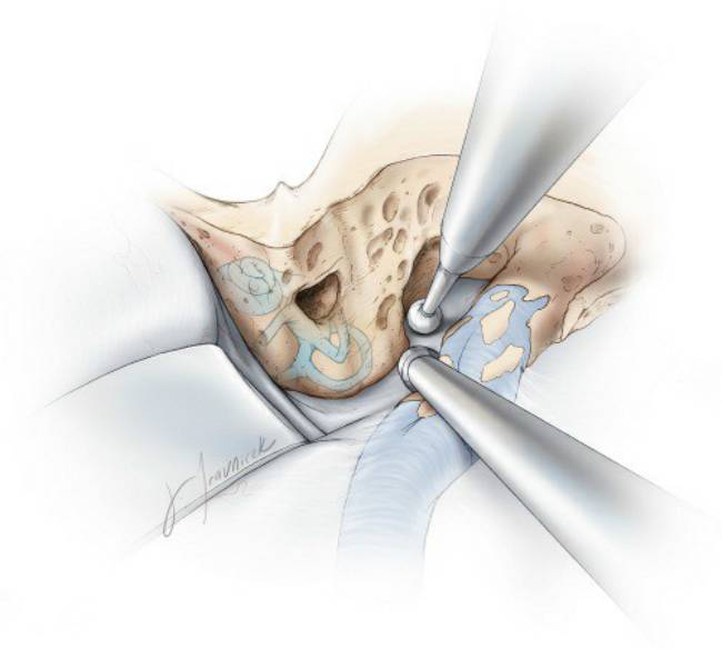 扩大经岩骨后入路手术技巧丨the neurosurgical atlas