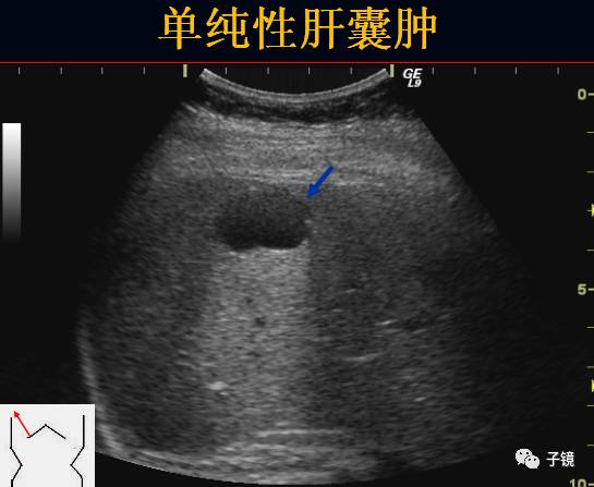 6,肝囊肿:发病率高,可有先天性,老年性,感染性,外伤性或肿瘤性.