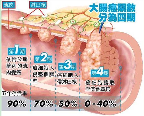 肠癌