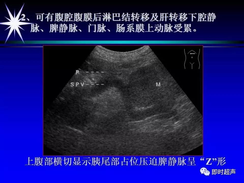 胰腺超声诊断