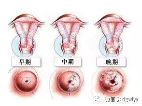 宫颈肥厚怎么办