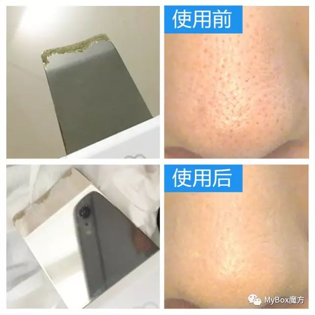 黑头铲的原理_touchbeauty超声波导入美容仪洁面去黑头铲皮机吸黑毛孔清洁神器