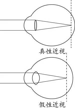 涨姿势如何分辨真假近视再盲目配眼镜小心弄假成真视频