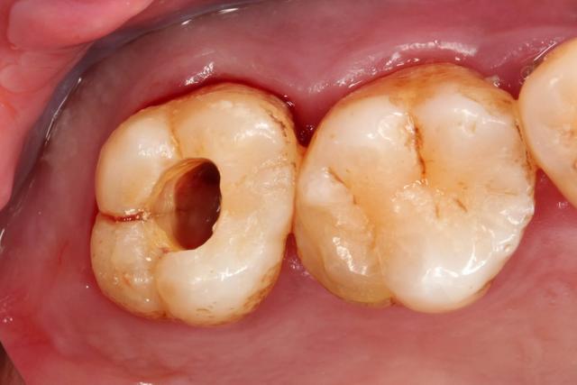 抽牙神经的真相究竟为什么要在牙齿上开个洞