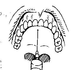 麻醉术:口腔局部麻醉