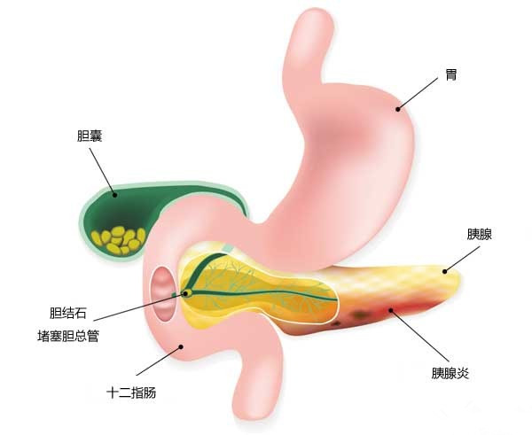 胆结石药物排石的原理_所以根据我们人自身的生理特点,理论上最大横径为0.6cm以下的结石都可