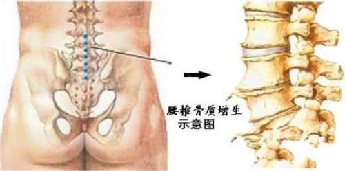 专业骨科医生介绍说:腰椎骨质增生是一种慢性,进展性关节病变,以腰三