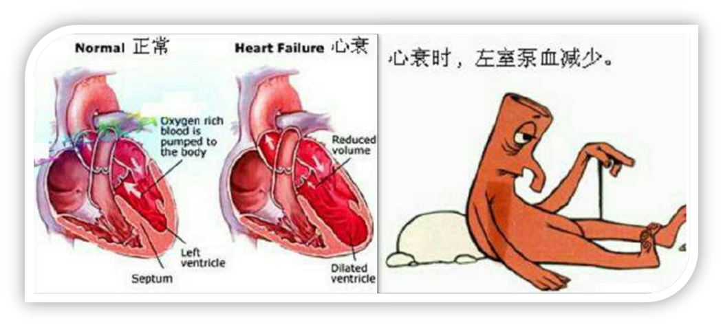 其中绝大多数的心力衰竭 都是以左心衰竭开始的,即首先表现为肺循环