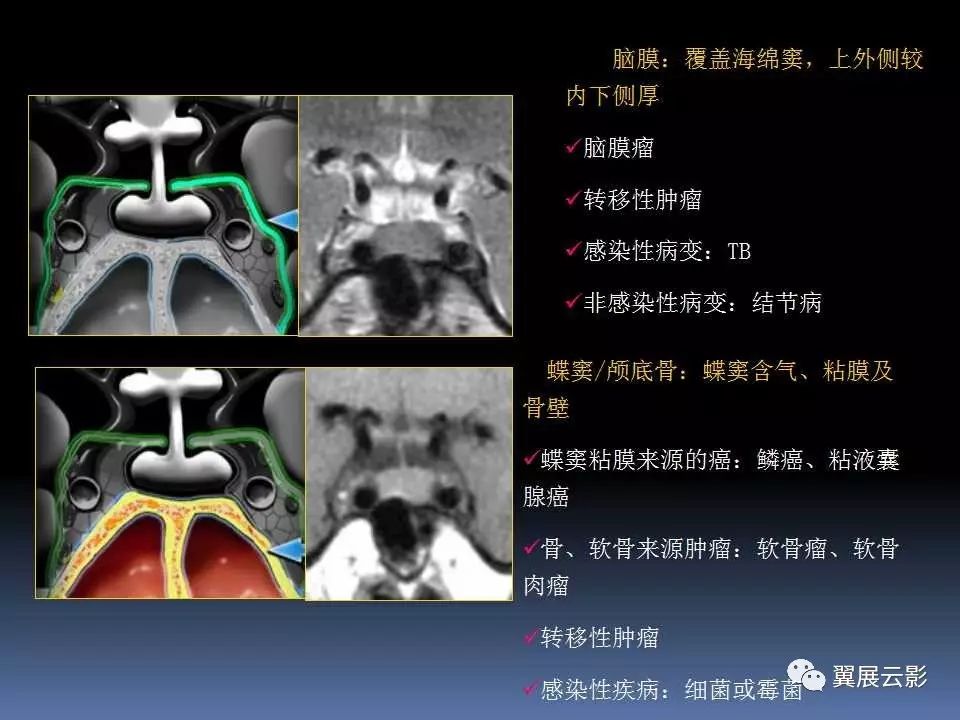 鞍区病变影像诊断