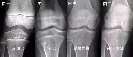 故而之所以成年之后不再长高也是因为骨骼已经闭合