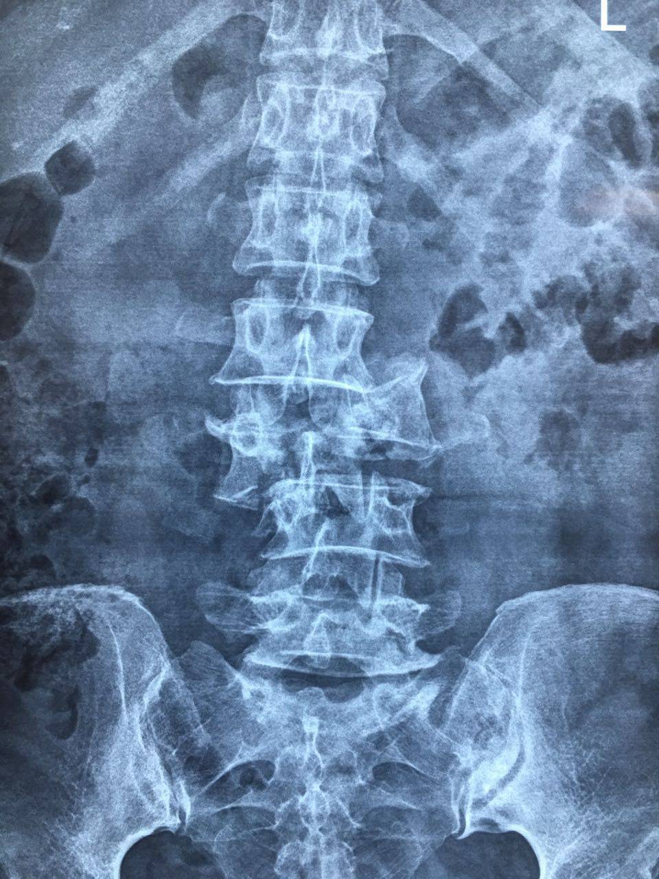 发现患者腰3椎体爆裂性骨折伴脱位,脊髓损伤,腰2,3,4椎体横突骨折
