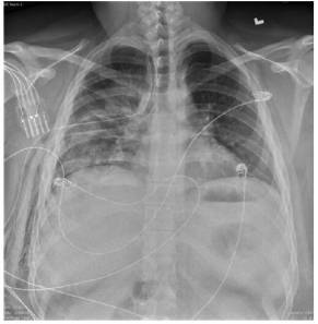 胸片提示气胸,箭头指示气胸线,可见气管及纵膈右偏.