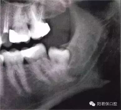 【收藏】拔牙技巧图解