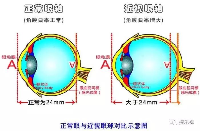 【视光知识】正常眼 和 近视眼 最大的 区别是什么?