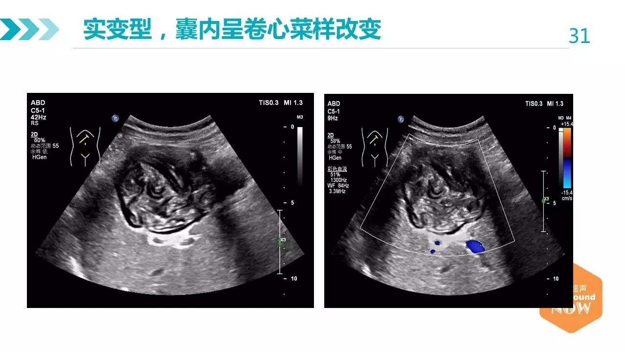 本次课堂邀请到青海省人民医院超声科对包虫病的影像诊断深入研究的陈