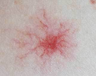 虽然蜘蛛痣是肝病在皮肤上的表现之一,但是有蜘蛛痣并不一定有肝