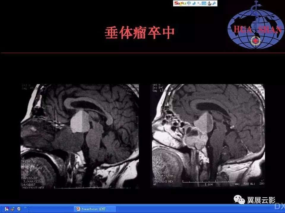 鞍区病变影像诊断