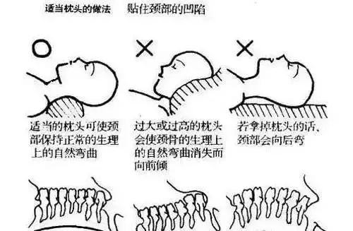 对策:枕头贴住颈部的凹陷中间低,两端高的元宝形保健枕头,弹性强,易