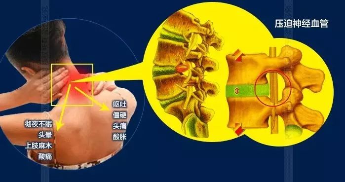 颈腰椎:颈椎间盘突出,颈椎不稳"卫生间光线一般较暗,不适合看任何电子