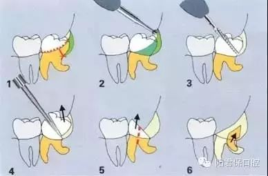 【收藏】拔牙技巧图解