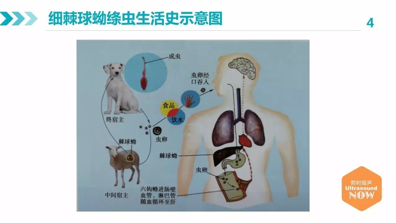 包虫病的影像学特点