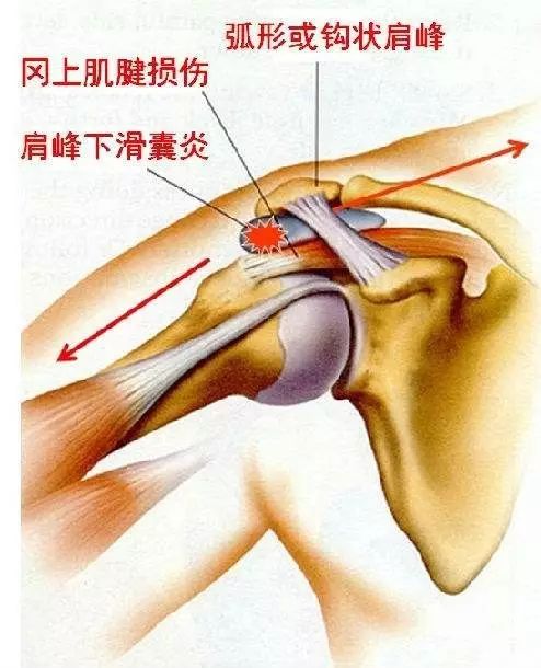 包括肩峰下滑囊炎,冈上肌腱炎,冈上肌腱钙化,肱二头肌长头肌腱炎等,其
