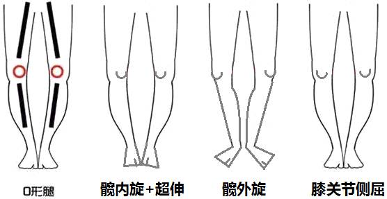 x型腿o型腿腿型不美怎么改善