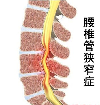 腰椎管狭窄症是指各种形式所导致的椎管以及神经管出现狭窄的情况