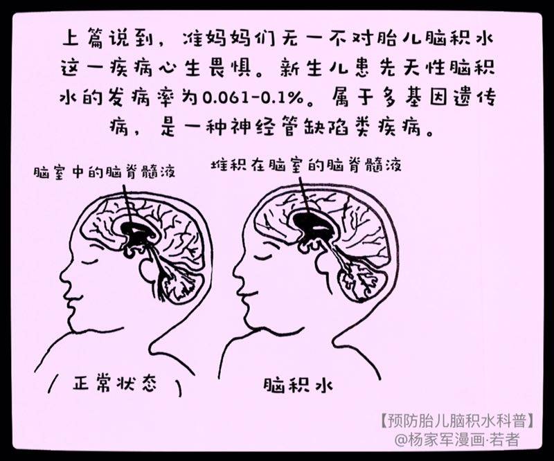 美女医生来说"画:预防胎儿脑积水,一起研究"生!