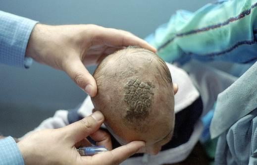 随着病情的深入,患者的头发会渐渐失去光泽,昏暗,枯萎,往往在刚出头皮