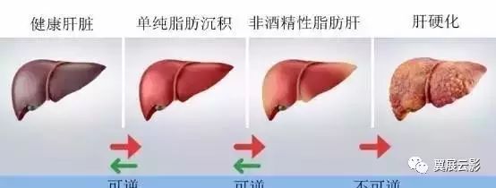 一文读懂脂肪肝的影像学表现(附多图实例)