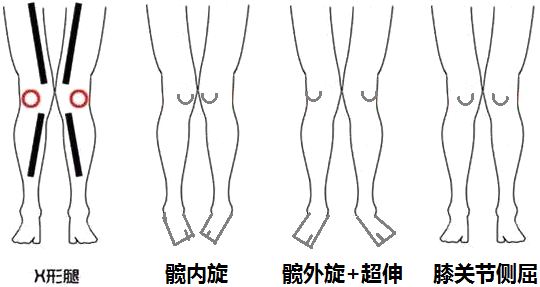 x型腿o型腿腿型不美怎么改善