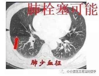 肺栓塞提高篇:ct平扫可发现,甚至诊断肺栓塞,看看国外