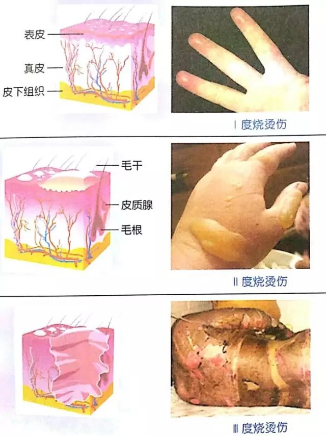 ii度烧烫伤:伤及真皮层,局部红肿,发热,疼痛难忍,有明显水泡.