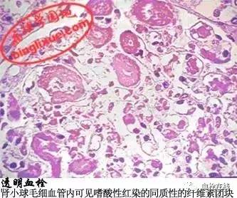 (4)透明血栓(hyaline thrombus):由变性蛋白组成.