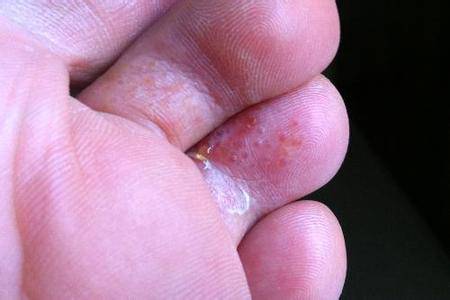 常见的真菌性皮肤病,以足癣为多见,人群患病率高达30~70,俗称"脚气"
