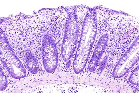 与乳糜泻及炎症性肠病(ibd):不同疾病的鉴别亦或疾病的转归?