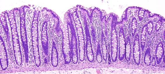 正常结肠粘膜显微镜下结肠炎(microscopic colitis, mc)是一种以慢性