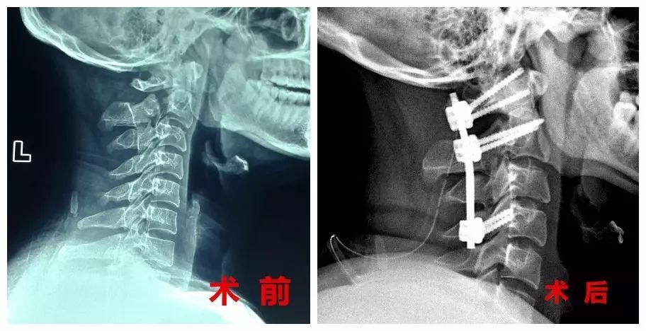 颈椎手术(2例)胸腰椎骨折钉板系统固定术(21例)老年性椎体压缩性骨折