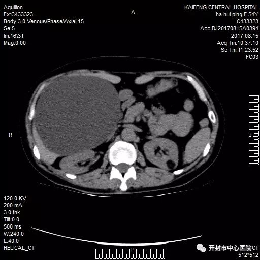 【科普】普外科腹腔镜微创系列治疗④——腹腔镜肝囊肿开窗去顶术