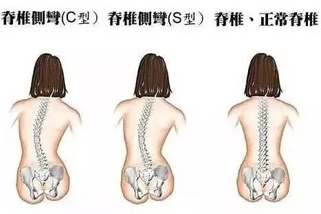 科普:脊柱侧弯加重,可能是遗传基因在"作祟"