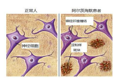 世界阿尔茨海默病日如何发现阿尔茨海默病早期症状