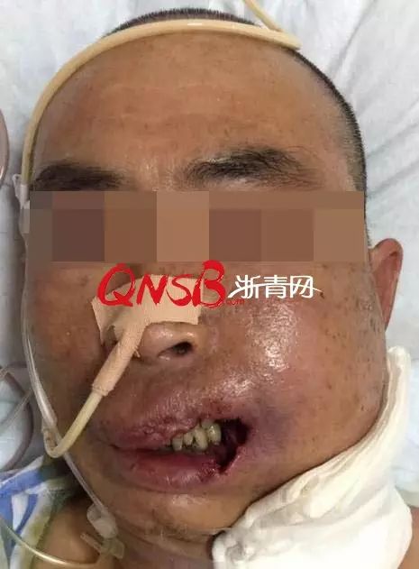 恐怖男子挤了一颗痘结果嘴唇烂光被连下2张病危通知书抢救了5天