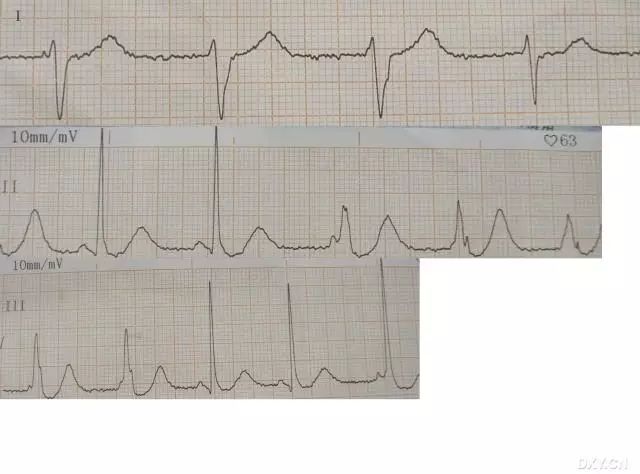 一份特殊的心电图你能看出是什么问题吗