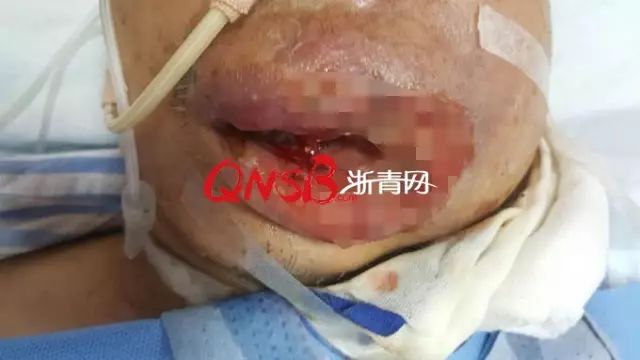 图片可能引起不适可怕浙江男子挤颗痘痘嘴唇烂光高烧不断两次病危通知