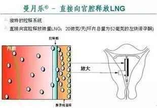 科普信息神奇的避孕环曼月乐