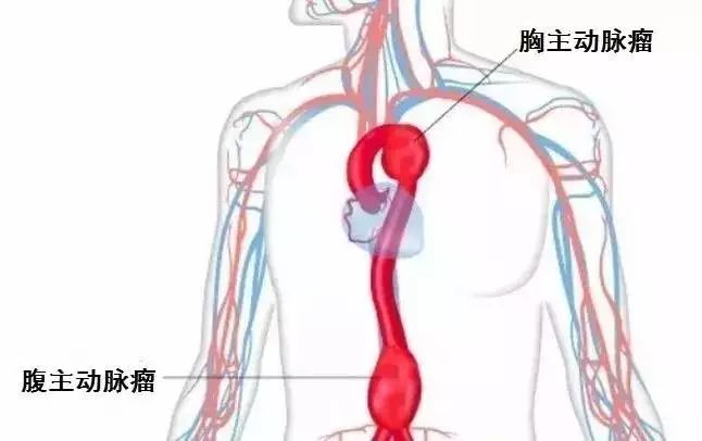 虽然叫腹主动脉瘤,但我们也可以看出它并不是癌症那样的恶性肿瘤